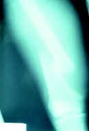 Fractura de la diáfisis femoral Fractura de la diáfisis femoral