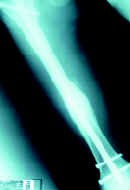 Diáfisis femoral con clavo intramedular bloqueado Diáfisis femoral con clavo intramedular bloqueado