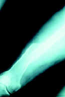 Fractura del tercio medio y distal del fémur Fractura del tercio medio y distal del fémur