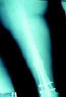 Fractura distal del fémur manejo quirúrgico Fractura distal del fémur manejo quirúrgico