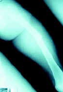 Fractura expuesta grado I del tercio medio del fémur  Fractura expuesta grado I del tercio medio del fémur