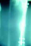 Fractura del tercio medio del fémur manejado con clavo bloqueado Fractura del tercio medio del fémur manejado con clavo bloqueado