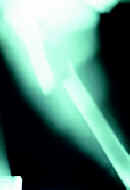 Fractura conminuta del fémur derecho Fractura conminuta del fémur derecho