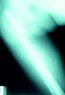 Fractura conminuta del fémur derecho manejo quirúrgico Fractura conminuta del fémur derecho manejo quirúrgico