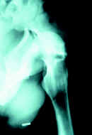 Luxofractura posterior de acetábulo Luxofractura posterior de acetábulo