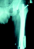 Fractura de la diáfisis femoral ipsilateral Fractura de la diáfisis femoral ipsilateral