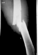 Fractura con placa de reconstrucción y clavo intramedular bloqueado Fractura con placa de reconstrucción y clavo intramedular bloqueado