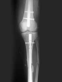  Fractura ipsilateral de la diáfisis femoral