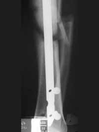 Bloqueo distal inadecuado Bloqueo distal inadecuado