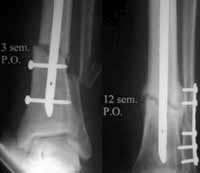 Deformidad posquirúrgica en valgo