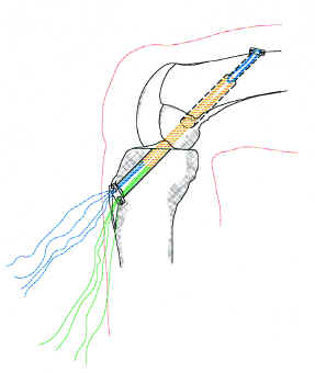 Botón proximal anclado en la cortical del fémur