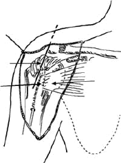 Reinserción del tendón del subescapular en la tuberosidad menor Reinserción del tendón del subescapular en la tuberosidad menor