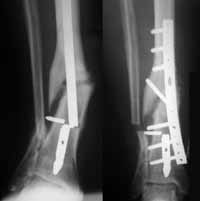 Ruptura del material de osteosíntesis secundaria