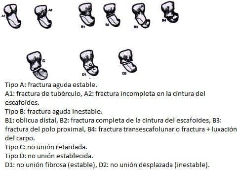 Clasificación de Herbert tipo de fracturas