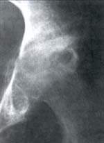 Ausencia espacio articular y trabeculación ósea coxo-femoral