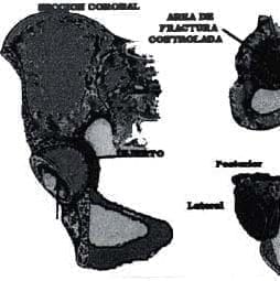 Copa con el injerto y la malla de Vitalium