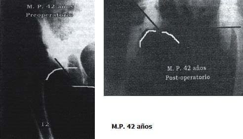 Escala de Harris de 26