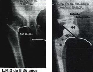 Deformidad en aducción y rotación externa, Escala de Harris de 27