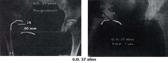 Escala de Harris  93 puntos