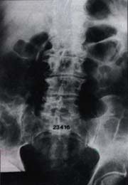 Espondiloartrosis de la región lumbosacra Espondiloartrosis de la región lumbosacra