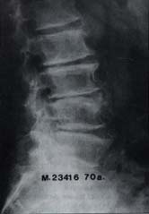 Espondiloartrosis de la región lumbosacra1 Espondiloartrosis de la región lumbosacra1