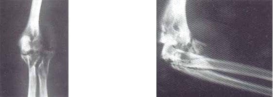 Radiografía AP y lateral de codo con fractura conminuta cúpula radial Radiografía AP y lateral de codo con fractura conminuta cúpula radial