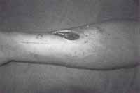 Incisión de piel y tejido celular subcutáneo Incisión de piel y tejido celular subcutáneo