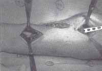 Paso o deslizamiento de placa de osteosíntesis subfacial Paso o deslizamiento de placa de osteosíntesis subfacial