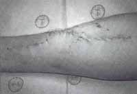 Liberación del torniquete fracturas abiertas Liberación del torniquete fracturas abiertas