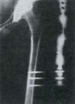 Fusión articular completa