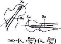 Forma de calcular la distancia punta-apex (TAD) Forma de calcular la distancia punta-apex (TAD)