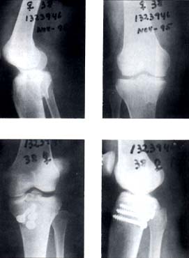 Fractura del platillo tibial posteromedial