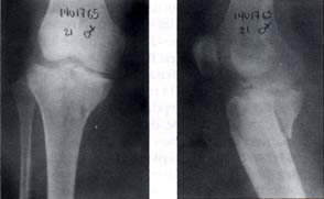 Fractura del platillo tibial posteromedial