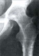 Fusión articular completa