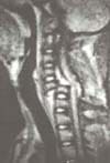 Luxifractura cervical C5-C5 Luxifractura cervical C5-C5