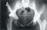 Pseudoartrosis de osteotomías 