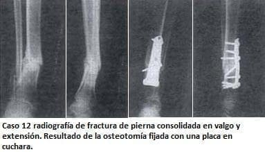 Radiografía de fractura de pierna consolidada en valgo Radiografía de fractura de pierna consolidada en valgo