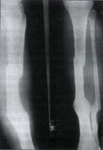 Método Ilizarov en pseudoartrosis distal Método Ilizarov en pseudoartrosis distal