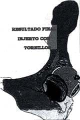 Resultado injerto con tornillos - técnica de Harris