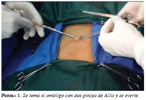 Se toma el ombligo con dos pinzas de Allis y se everte