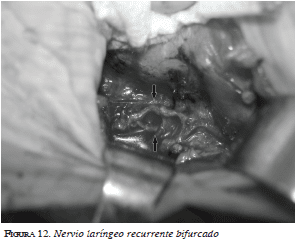 Nervio laríngeo recurrente bifurcado Nervio laríngeo recurrente bifurcado