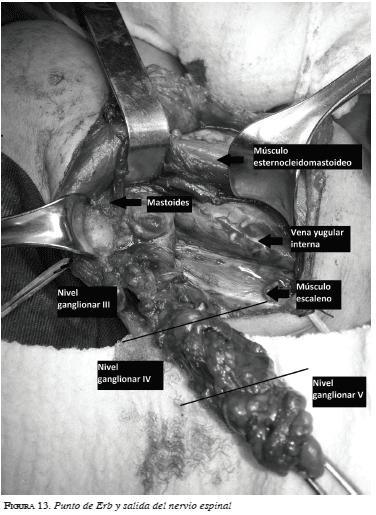 Punto de Erb y salida del nervio espinal Punto de Erb y salida del nervio espinal