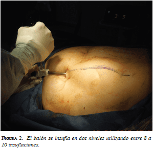 Balón se insufla en dos niveles