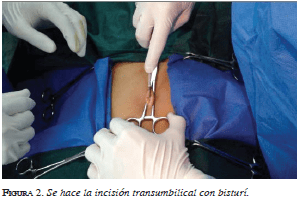 Se hace la incisión transumbilical con bisturí Se hace la incisión transumbilical con bisturí