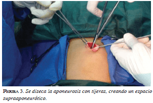 Se diseca la aponeurosis con tijeras, creando un espacio supraaponeurótico Se diseca la aponeurosis con tijeras, creando un espacio supraaponeurótico