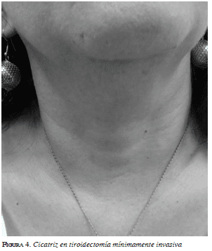 Cicatriz en tiroidectomía mínimamente invasiva