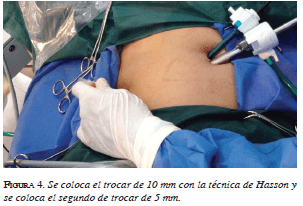 Técnica de Hasson Técnica de Hasson