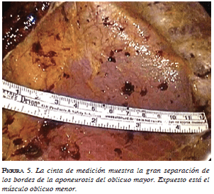 La cinta de medición muestra la gran separación de los bordes de la aponeurosis del oblicuo mayor La cinta de medición muestra la gran separación de los bordes de la aponeurosis del oblicuo mayor