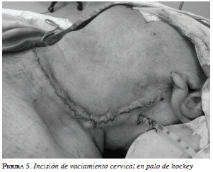 Incisión de vaciamiento cervical en palo de hockey Incisión de vaciamiento cervical en palo de hockey