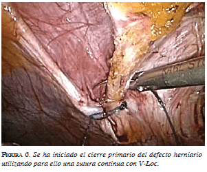 Cierre primario del defecto herniario Cierre primario del defecto herniario